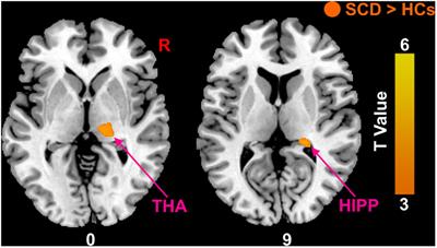 Percentage amplitude of fluctuation and structural covariance changes of subjective cognitive decline in patients: A multimodal imaging study